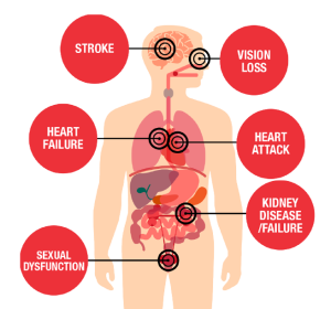 causes of hypertension- high blood pressure